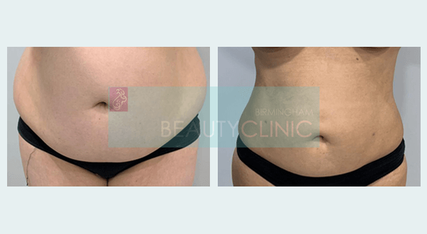 mini-stomach-liposuction-before-and-after