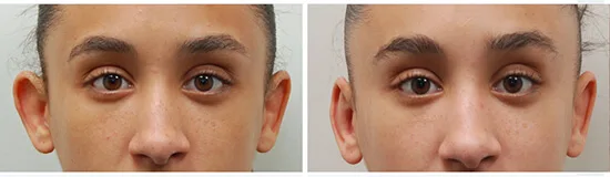 otoplasty-before-and-after