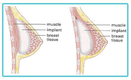 breast-implants-types