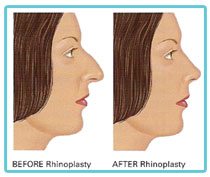 rhinoplasty-nose-correction