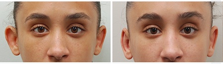 ear-correction-otoplasty-before-after