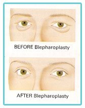 eyelid-surgery-birmingham