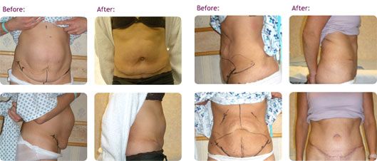 Tummy Tuck (Abdominoplasty), Cosmetic Surgery UK