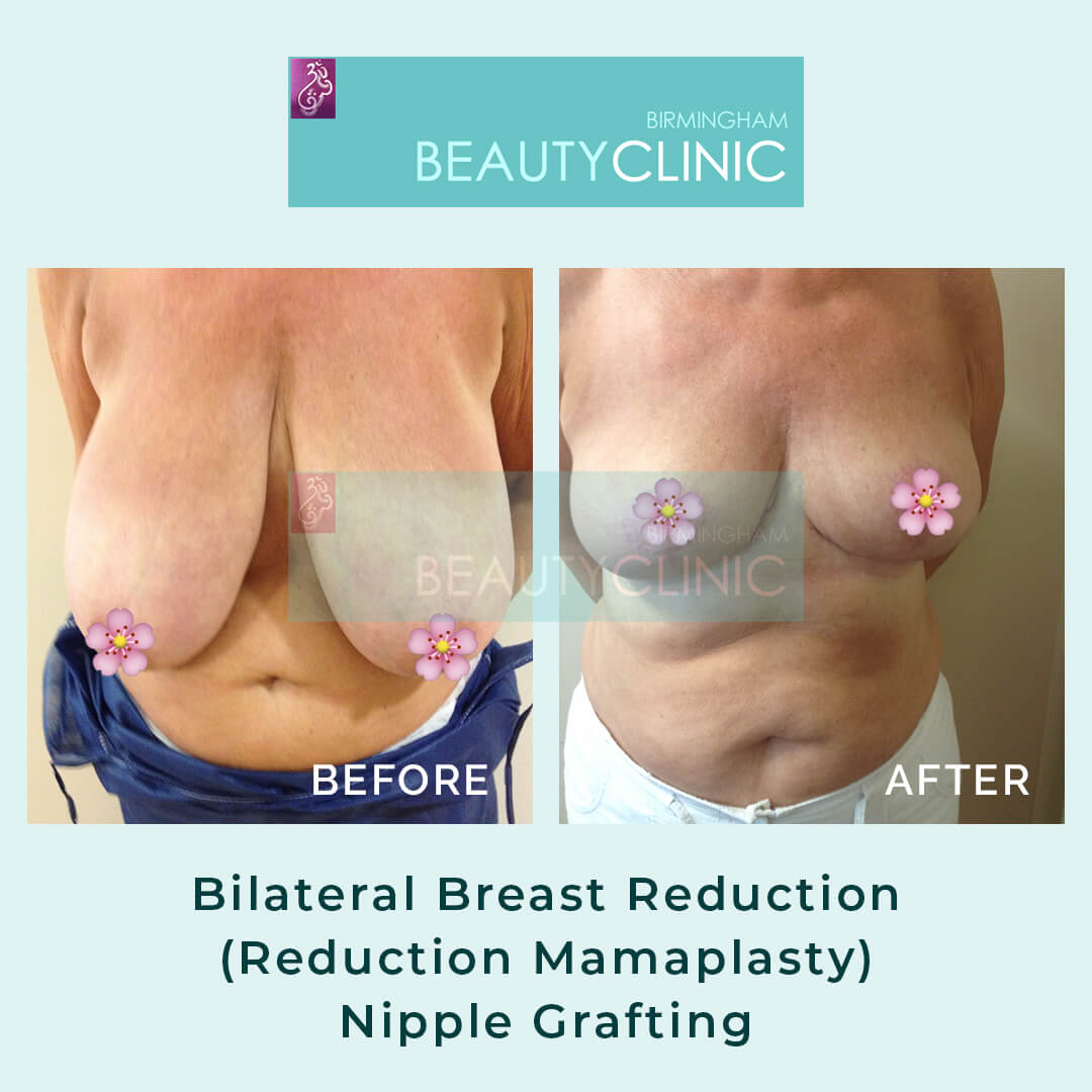 Bilateral Breast Reduction (Reduction Mamaplasty) _ Nipple grafting