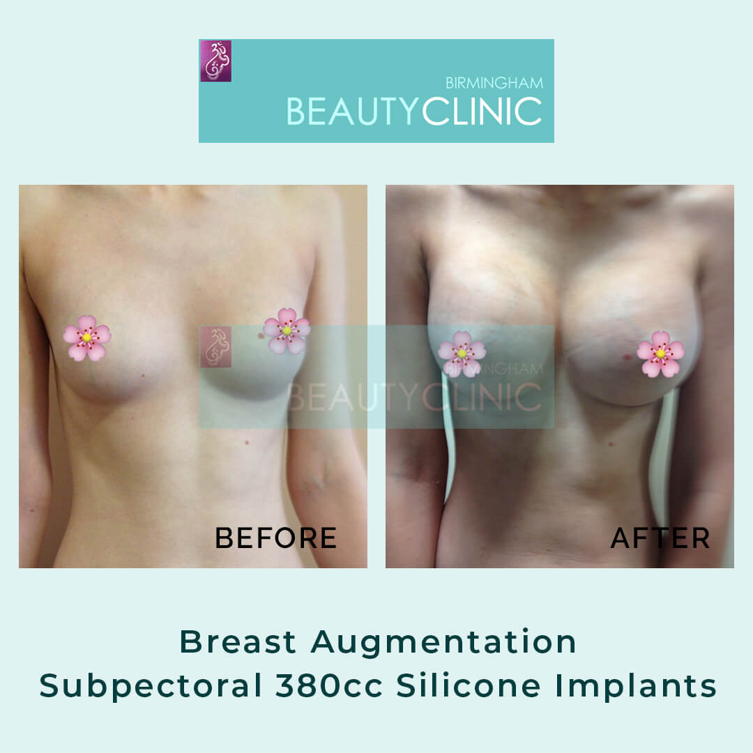 Breast Augmentation-Subpectoral-380cc