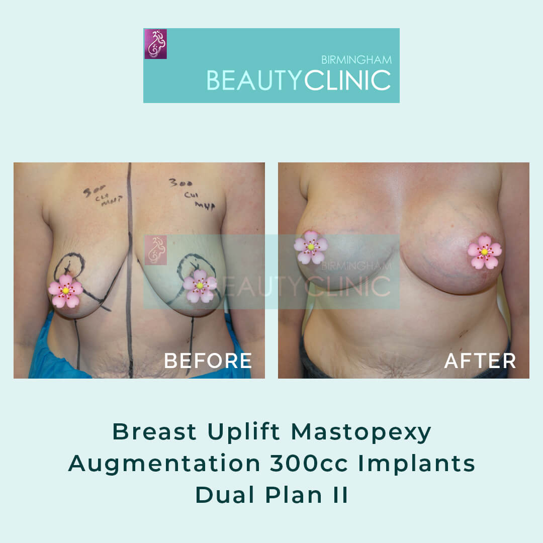Breast_uplift__mastopexy_augmentation_300cc_implants_dual plan II
