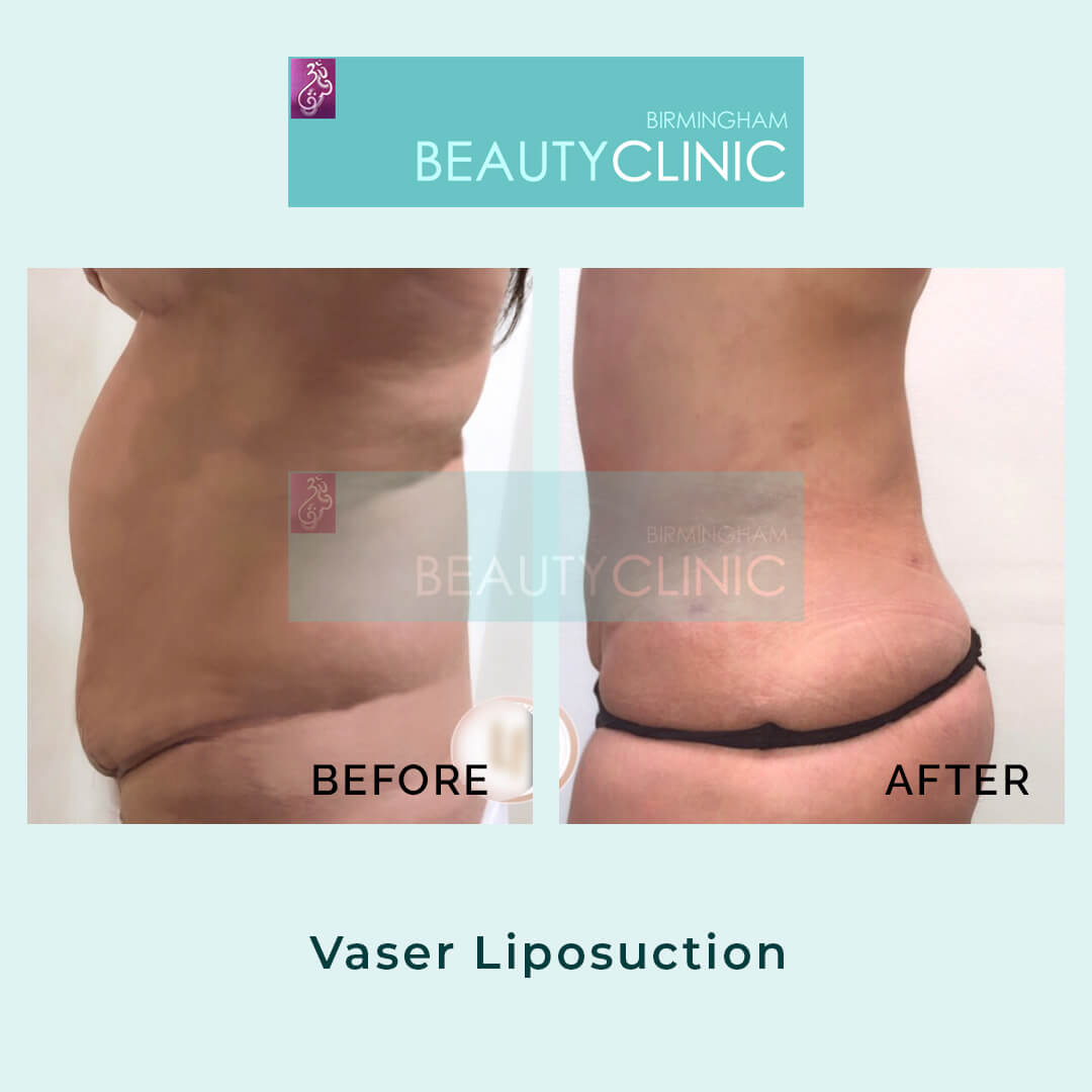 vaser liposuction before after