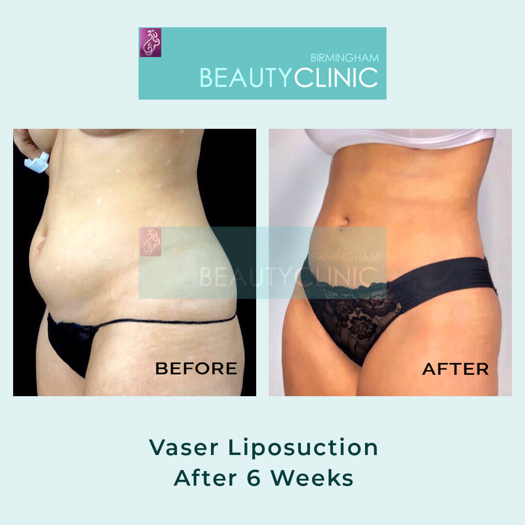 vaser liposuction before after