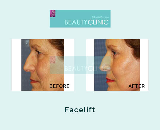 facelift - before and after 1