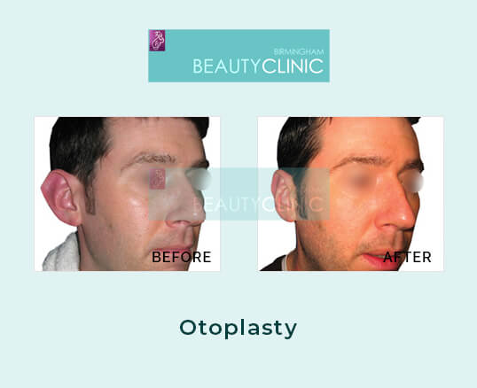 otoplasty - before and after