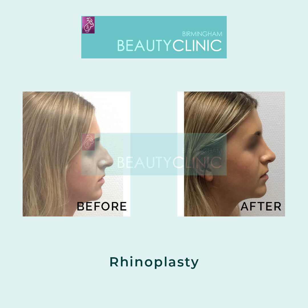 rhinoplasty - before and after