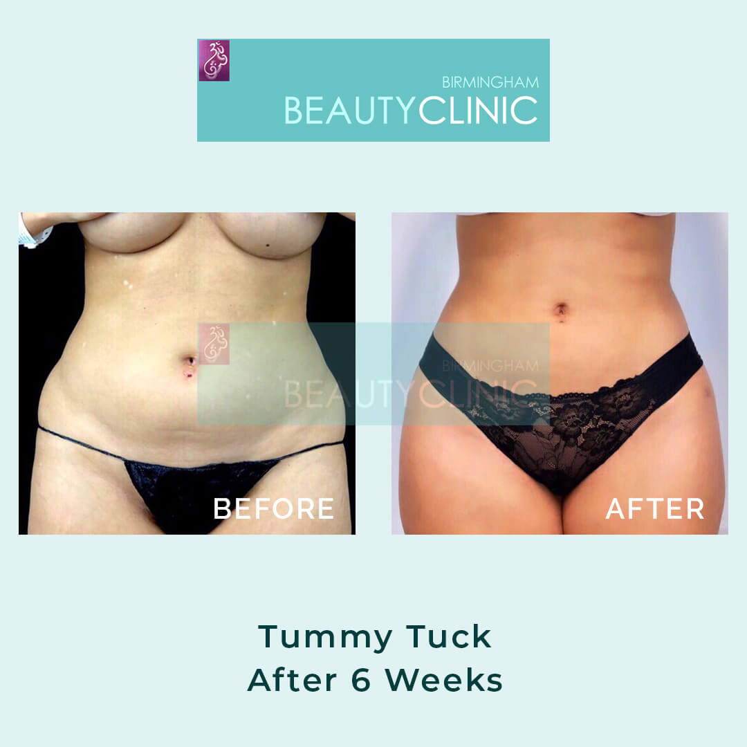 tummy tuck - before and after