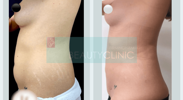abdomen liposuction before and after 2 month