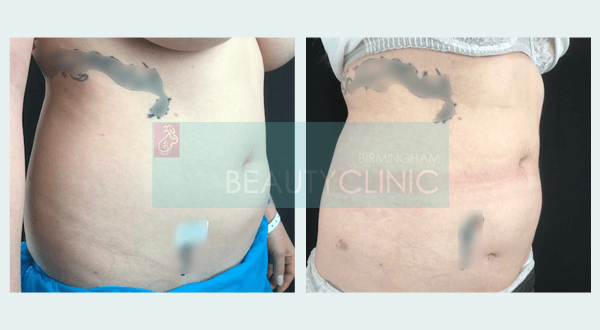 abdomen liposuction before and after