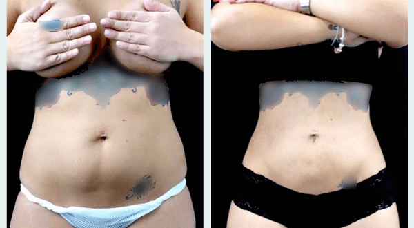 abdominoplasty before and after 3 months