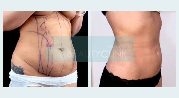 abdominoplasty before and after uk