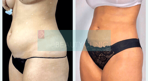 female tummy tuck before and after
