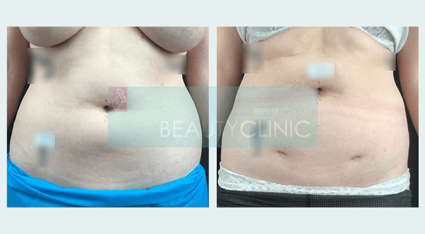 liposuction before and after stomach