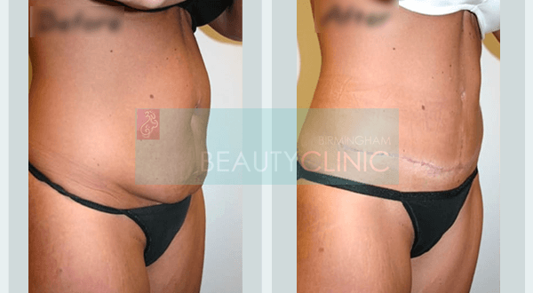 mini abdominoplasty before and after
