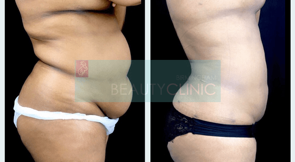 mini tummy tuck before and after uk