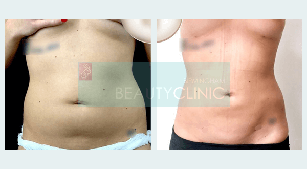 stomach liposuction before and after 3 month