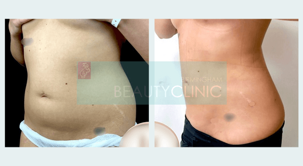 stomach liposuction before and after 3 months