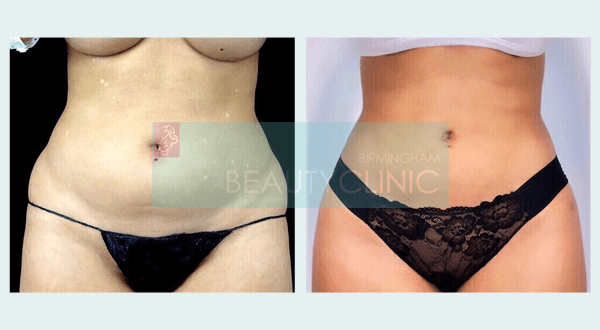 stomach liposuction before and after 6 weeks