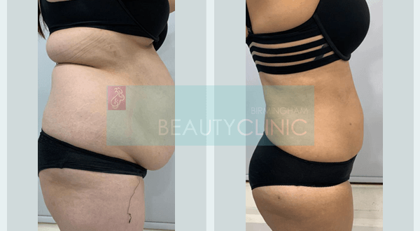 stomach liposuction before and after one month