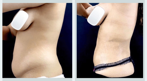 tummy tuck before and after uk