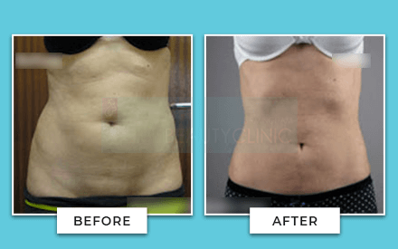 https://www.birminghambeautyclinic.co.uk/wp-content/uploads/2021/05/tummy-tuck-before-and-after-5.png