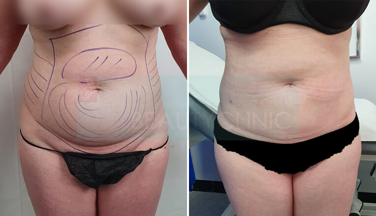 Liposuction Birmingham UK, Liposuction Before and After